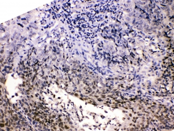 HDGF Antibody - IHC testing of FFPE human lung carcinoma with HDGF antibody at 1ug/ml. HIER: steam section in pH6 citrate buffer for 20 min.