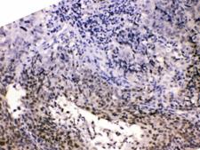 HDGF Antibody - IHC testing of FFPE human lung carcinoma with HDGF antibody at 1ug/ml. HIER: steam section in pH6 citrate buffer for 20 min.