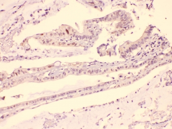 HDGF Antibody - IHC testing of FFPE human intestinal carcinoma with HDGF antibody at 1ug/ml. HIER: steam section in pH6 citrate buffer for 20 min.