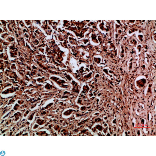 HDGF Antibody - Immunohistochemical analysis of paraffin-embedded human-breast-cancer, antibody was diluted at 1:200.