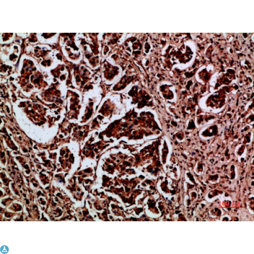 HDGF Antibody - Immunohistochemical analysis of paraffin-embedded human-breast-cancer, antibody was diluted at 1:200.