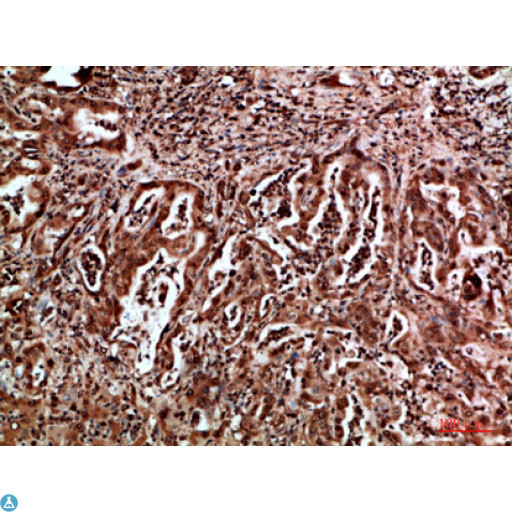HDGF Antibody - Immunohistochemical analysis of paraffin-embedded human-liver-cancer, antibody was diluted at 1:200.