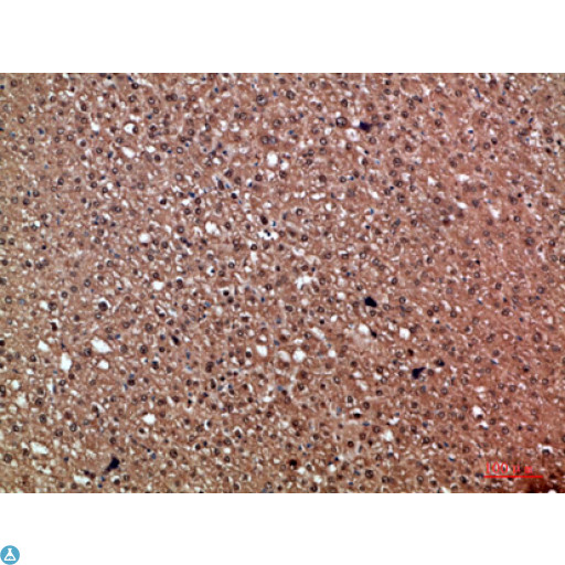 HDGF Antibody - Immunohistochemical analysis of paraffin-embedded human-liver-cancer, antibody was diluted at 1:200.