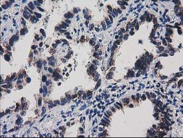 HDHD1 Antibody - IHC of paraffin-embedded Carcinoma of Human thyroid tissue using anti-HDHD1A mouse monoclonal antibody.