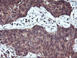 HDHD1 Antibody - IHC of paraffin-embedded Carcinoma of Human lung tissue using anti-HDHD1 mouse monoclonal antibody.