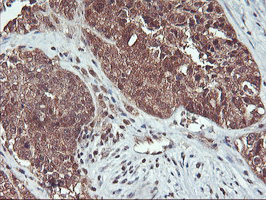 HDHD1 Antibody - IHC of paraffin-embedded Adenocarcinoma of Human ovary tissue using anti-HDHD1 mouse monoclonal antibody.