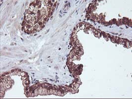 HDHD1 Antibody - IHC of paraffin-embedded Carcinoma of Human prostate tissue using anti-HDHD1 mouse monoclonal antibody.