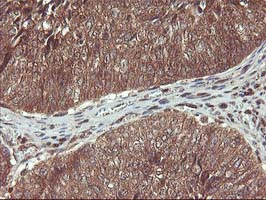 HDHD1 Antibody - IHC of paraffin-embedded Carcinoma of Human bladder tissue using anti-HDHD1 mouse monoclonal antibody.