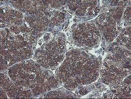 HDHD1 Antibody - IHC of paraffin-embedded Carcinoma of Human liver tissue using anti-HDHD1 mouse monoclonal antibody.