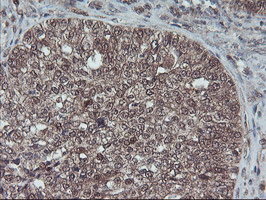 HDHD1 Antibody - IHC of paraffin-embedded Adenocarcinoma of Human ovary tissue using anti-HDHD1 mouse monoclonal antibody.