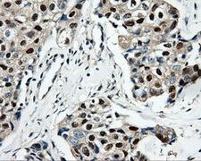 HDHD2 Antibody - Immunohistochemical staining of paraffin-embedded Adenocarcinoma of breast tissue using anti-HDHD2 mouse monoclonal antibody. (Dilution 1:50).