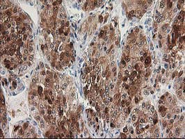HDHD2 Antibody - IHC of paraffin-embedded Carcinoma of Human liver tissue using anti-HDHD2 mouse monoclonal antibody.