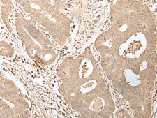 HDHD2 Antibody - Immunohistochemistry of paraffin-embedded Human gastric cancer tissue  using HDHD2 Polyclonal Antibody at dilution of 1:40(×200)