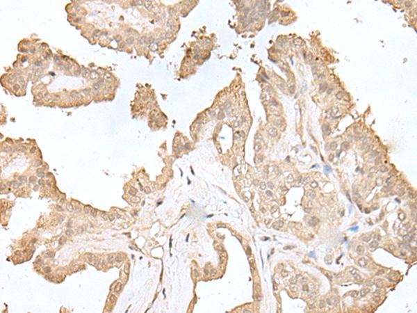 HDHD2 Antibody - Immunohistochemistry of paraffin-embedded Human thyroid cancer tissue  using HDHD2 Polyclonal Antibody at dilution of 1:40(×200)