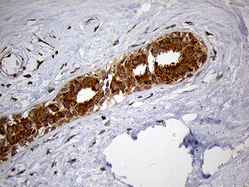 HDHD3 Antibody - Immunohistochemical staining of paraffin-embedded Human breast tissue within the normal limits using anti-HDHD3 mouse monoclonal antibody. (Heat-induced epitope retrieval by 1mM EDTA in 10mM Tris buffer. (pH8.5) at 120°C for 3 min. (1:150)
