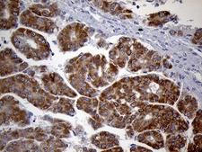 HDHD3 Antibody - Immunohistochemical staining of paraffin-embedded Carcinoma of Human liver tissue using anti-HDHD3 mouse monoclonal antibody. (Heat-induced epitope retrieval by 1mM EDTA in 10mM Tris buffer. (pH8.5) at 120°C for 3 min. (1:150)