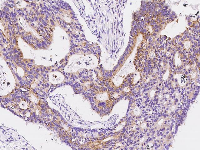 HDHD3 Antibody - Immunochemical staining of human HDHD3 in human colon carcinoma with rabbit polyclonal antibody at 1:300 dilution, formalin-fixed paraffin embedded sections.