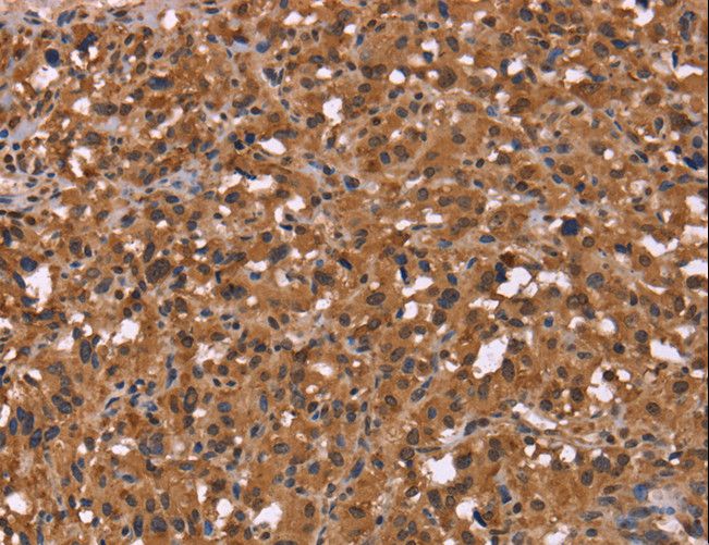 HDLBP / Vigilin Antibody - Immunohistochemistry of paraffin-embedded Human thyroid cancer using HDLBP Polyclonal Antibody at dilution of 1:50.