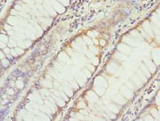 HDS / DHDDS Antibody - Immunohistochemistry of paraffin-embedded human rectal cancer at dilution 1:100