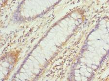 HDS / DHDDS Antibody - Immunohistochemistry of paraffin-embedded human rectal cancer at dilution 1:100