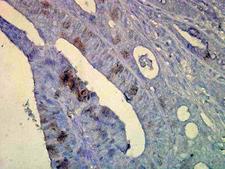 Heat Shock Protein 70 / HSPA1A Antibody - Immunohistochemical staining of inflammatory cells in human colon tissue