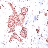 Heat Shock Protein 70 / HSPA1A Antibody - Human breast ca. stained with Anti-HSP70
