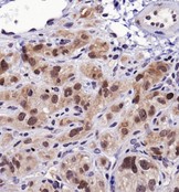 Heat Shock Protein 70 / HSPA1A Antibody - Immunohistochemistry: Hsp70 Antibody - Analysis of Hsp70 in human xenograft kidney cancer using DAB with hematoxylin counterstain.  This image was taken for the unconjugated form of this product. Other forms have not been tested.
