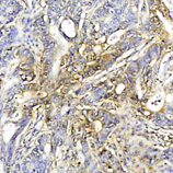 Heat Shock Protein 70 / HSPA1A Antibody - Immunohistochemistry of human colon cancer tissue using HSP70 monoclonal antibody (C92F3A-5) at a dilution of 1:50.