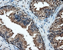 Heat Shock Protein 70 / HSPA1A Antibody - Immunohistochemical staining of paraffin-embedded prostate tissue using anti-HSPA1A mouse monoclonal antibody. (Dilution 1:50).