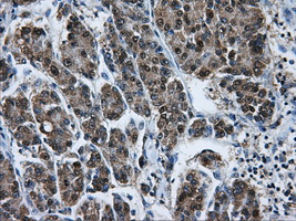 Heat Shock Protein 70 / HSPA1A Antibody - Immunohistochemical staining of paraffin-embedded Carcinoma of liver tissue using anti-HSPA1A mouse monoclonal antibody. (Dilution 1:50).