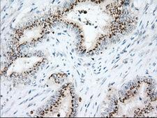 Heat Shock Protein 70 / HSPA1A Antibody - IHC of paraffin-embedded Adenocarcinoma of Human colon tissue using anti-HSPA1A mouse monoclonal antibody. (Dilution 1:50).