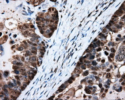 Heat Shock Protein 70 / HSPA1A Antibody - Immunohistochemical staining of paraffin-embedded Adenocarcinoma of ovary tissue using anti-HSPA1A mouse monoclonal antibody. (Dilution 1:50).