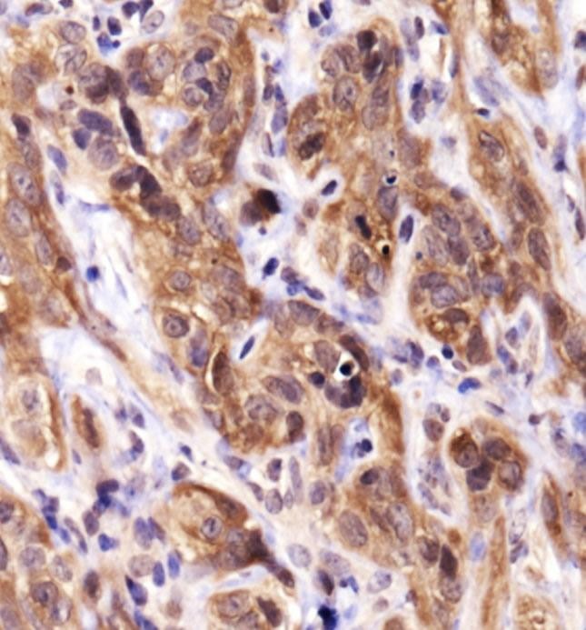 Heat Shock Protein 70 / HSPA1A Antibody - Immunohistochemistry: Hsp70 Antibody - Analysis of Hsp70 in human xenograft kidney cancer using DAB with hematoxylin counterstain.  This image was taken for the unconjugated form of this product. Other forms have not been tested.