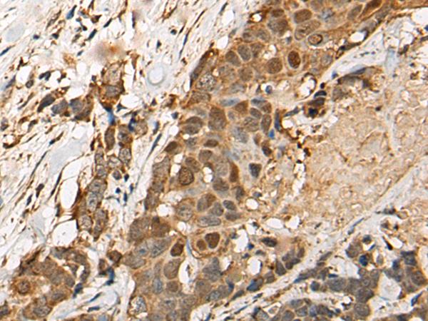 HEATR9 Antibody - Immunohistochemistry of paraffin-embedded Human thyroid cancer tissue  using HEATR9 Polyclonal Antibody at dilution of 1:110(×200)