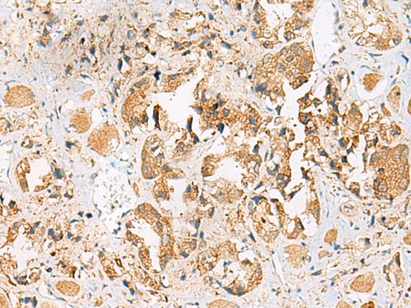 HEBP1 Antibody - Immunohistochemistry of paraffin-embedded Human prost ate cancer tissue  using HEBP1 Polyclonal Antibody at dilution of 1:40(×200)