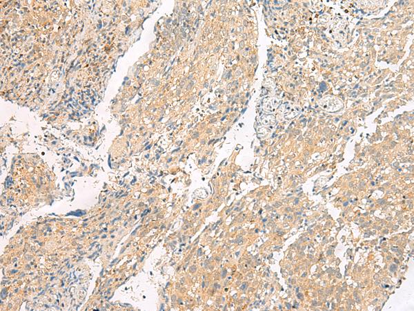 HEBP1 Antibody - Immunohistochemistry of paraffin-embedded Human cervical cancer tissue  using HEBP1 Polyclonal Antibody at dilution of 1:60(×200)