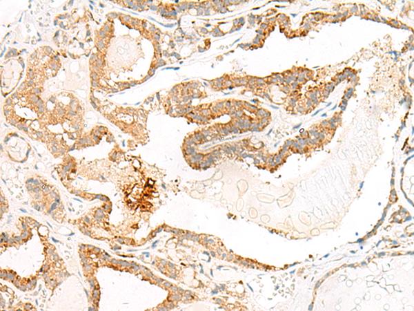HEBP1 Antibody - Immunohistochemistry of paraffin-embedded Human thyroid cancer tissue  using HEBP1 Polyclonal Antibody at dilution of 1:60(×200)