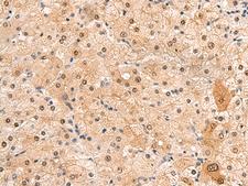 HEBP2 Antibody - Immunohistochemistry of paraffin-embedded Human liver cancer tissue  using HEBP2 Polyclonal Antibody at dilution of 1:60(×200)