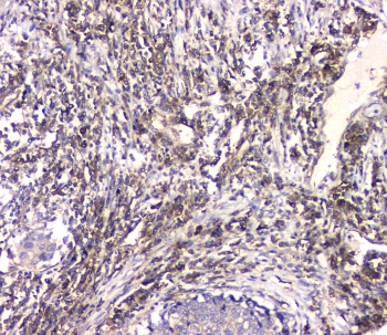 HECTD3 Antibody - IHC staining of FFPE human lung tissue with HECTD3 antibody at 1ug/ml. HIER: boil tissue sections in pH6, 10mM citrate buffer, for 10-20 min and allow to cool before testing.