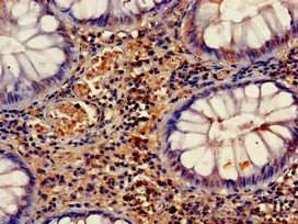 HELLS Antibody - Immunohistochemistry of paraffin-embedded human colon cancer using HELLS Antibody at dilution of 1:100