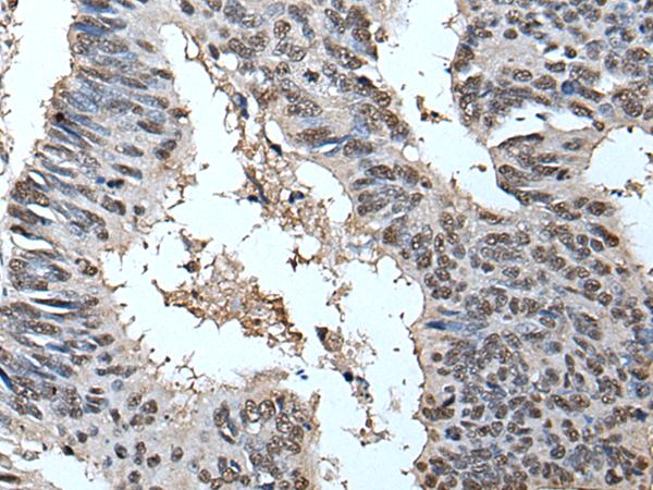 HELLS Antibody - Immunohistochemistry of paraffin-embedded Human colorectal cancer tissue  using HELLS Polyclonal Antibody at dilution of 1:30(×200)