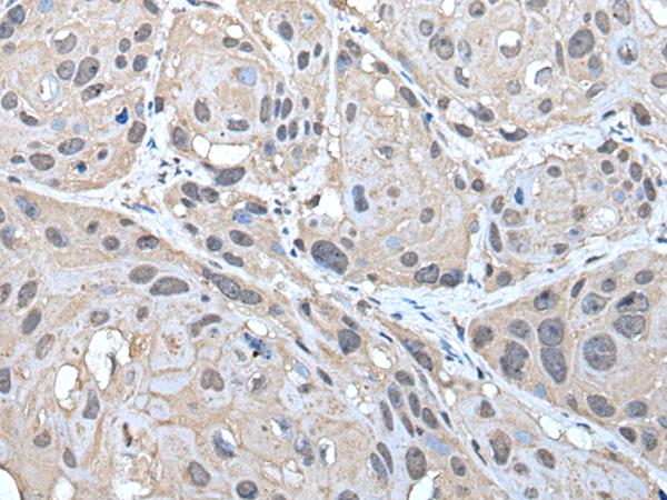 HELLS Antibody - Immunohistochemistry of paraffin-embedded Human esophagus cancer tissue  using HELLS Polyclonal Antibody at dilution of 1:30(×200)