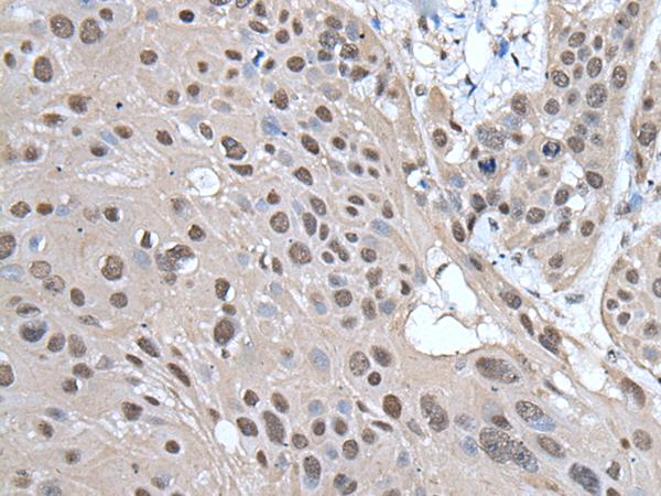 HELLS Antibody - Immunohistochemistry of paraffin-embedded Human esophagus cancer tissue  using HELLS Polyclonal Antibody at dilution of 1:65(×200)