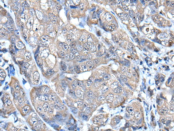 HELLS Antibody - Immunohistochemistry of paraffin-embedded Human breast cancer tissue  using HELLS Polyclonal Antibody at dilution of 1:65(×200)