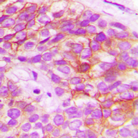 HELO1 / ELOVL5 Antibody - Immunohistochemical analysis of ELOVL5 staining in human breast cancer formalin fixed paraffin embedded tissue section. The section was pre-treated using heat mediated antigen retrieval with sodium citrate buffer (pH 6.0). The section was then incubated with the antibody at room temperature and detected using an HRP conjugated compact polymer system. DAB was used as the chromogen. The section was then counterstained with hematoxylin and mounted with DPX.