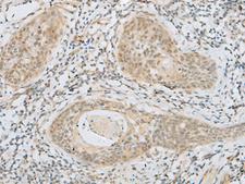 HELT Antibody - Immunohistochemistry of paraffin-embedded Human esophagus cancer tissue  using HELT Polyclonal Antibody at dilution of 1:40(×200)