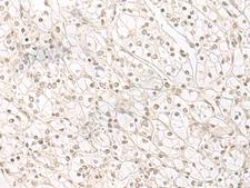 HENMT1 Antibody - Immunohistochemistry of paraffin-embedded Human kidney cancer tissue  using HENMT1 Polyclonal Antibody at dilution of 1:30(×200)