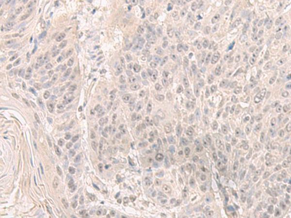 HENMT1 Antibody - Immunohistochemistry of paraffin-embedded Human esophagus cancer tissue  using HENMT1 Polyclonal Antibody at dilution of 1:30(×200)