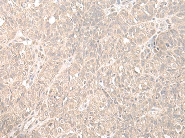 HENMT1 Antibody - Immunohistochemistry of paraffin-embedded Human ovarian cancer tissue  using HENMT1 Polyclonal Antibody at dilution of 1:35(×200)