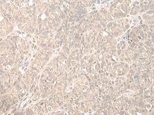 HENMT1 Antibody - Immunohistochemistry of paraffin-embedded Human ovarian cancer tissue  using HENMT1 Polyclonal Antibody at dilution of 1:35(×200)